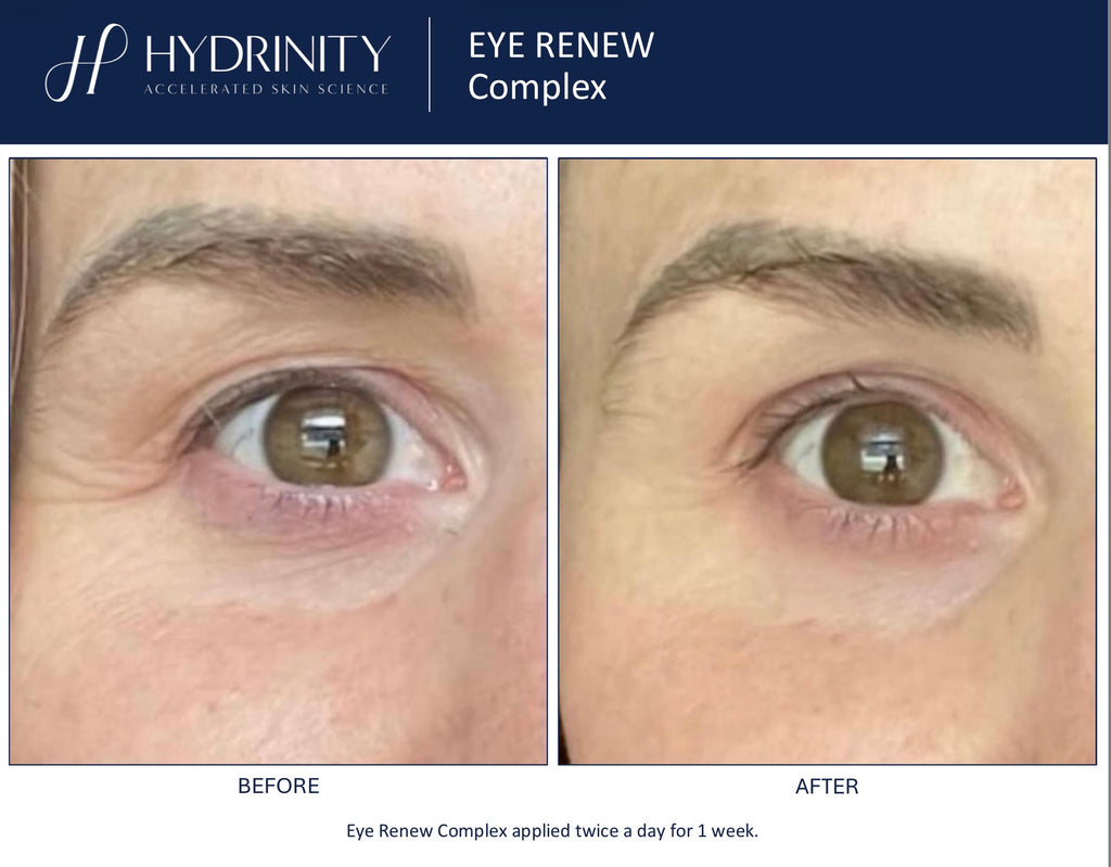 Eye Renew Complex